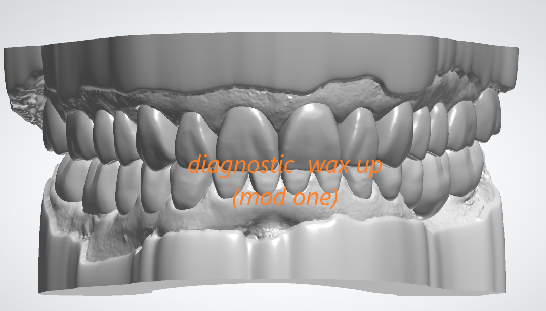 Diagnostic  wax up(mod one)